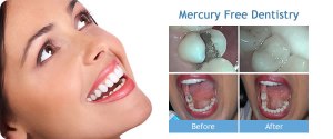 mercury-free-dentistry